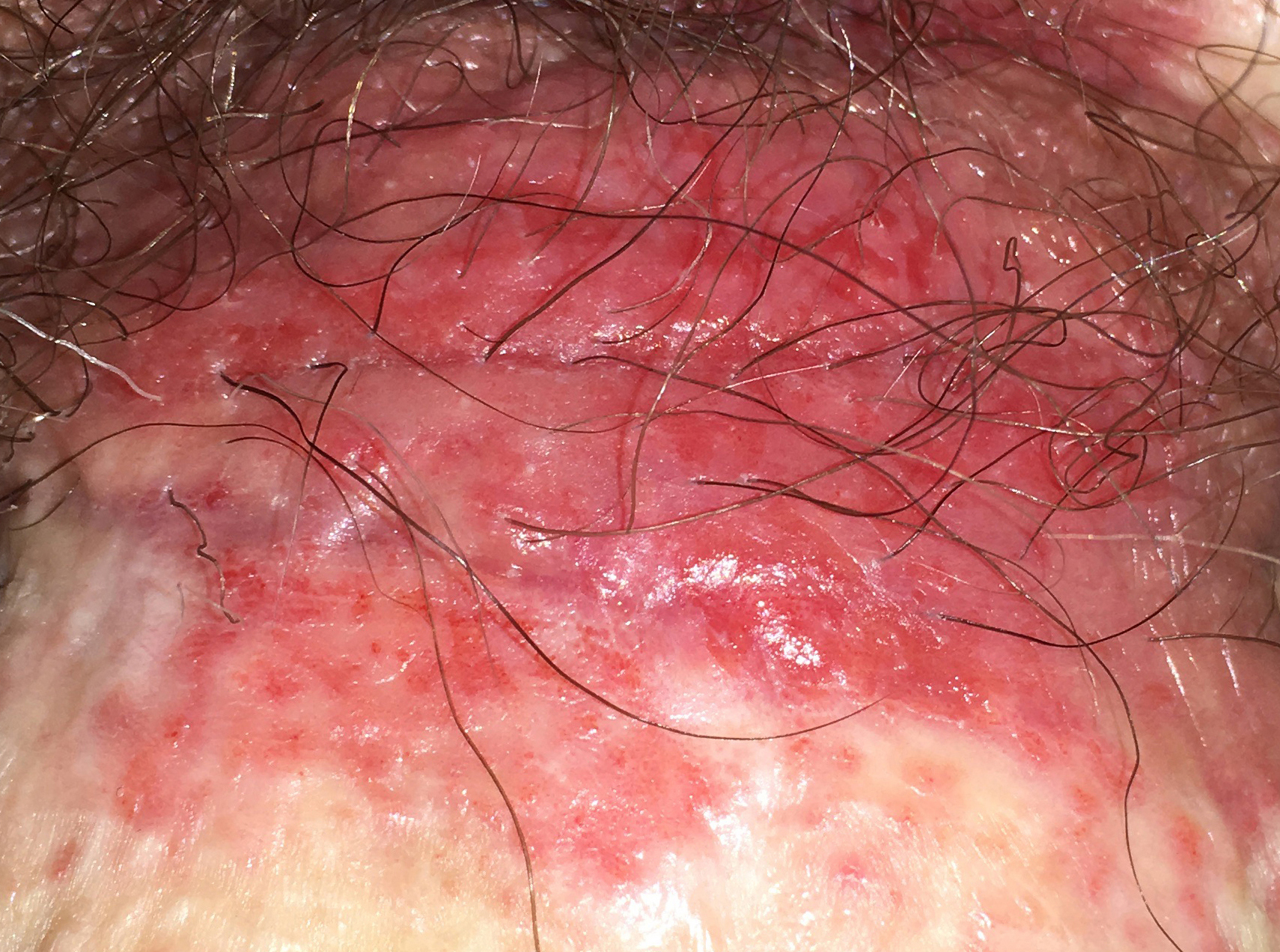 Genital Periorificial Dermatitis