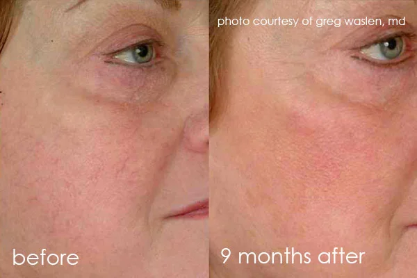 before-and-after-cutera-vein-face2.jpg