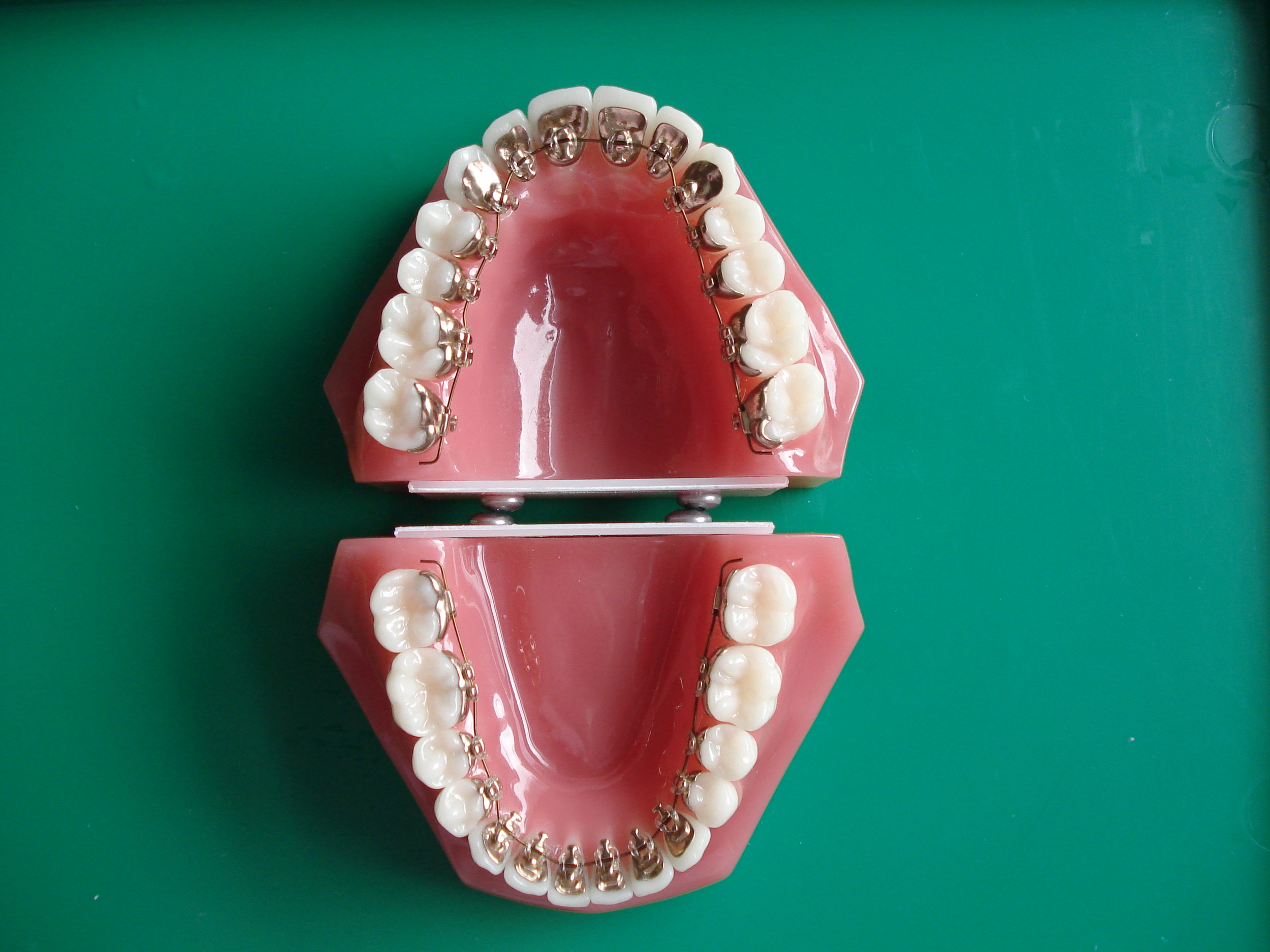 Double arch Incognito Lingual Braces mounted on a plastic model.