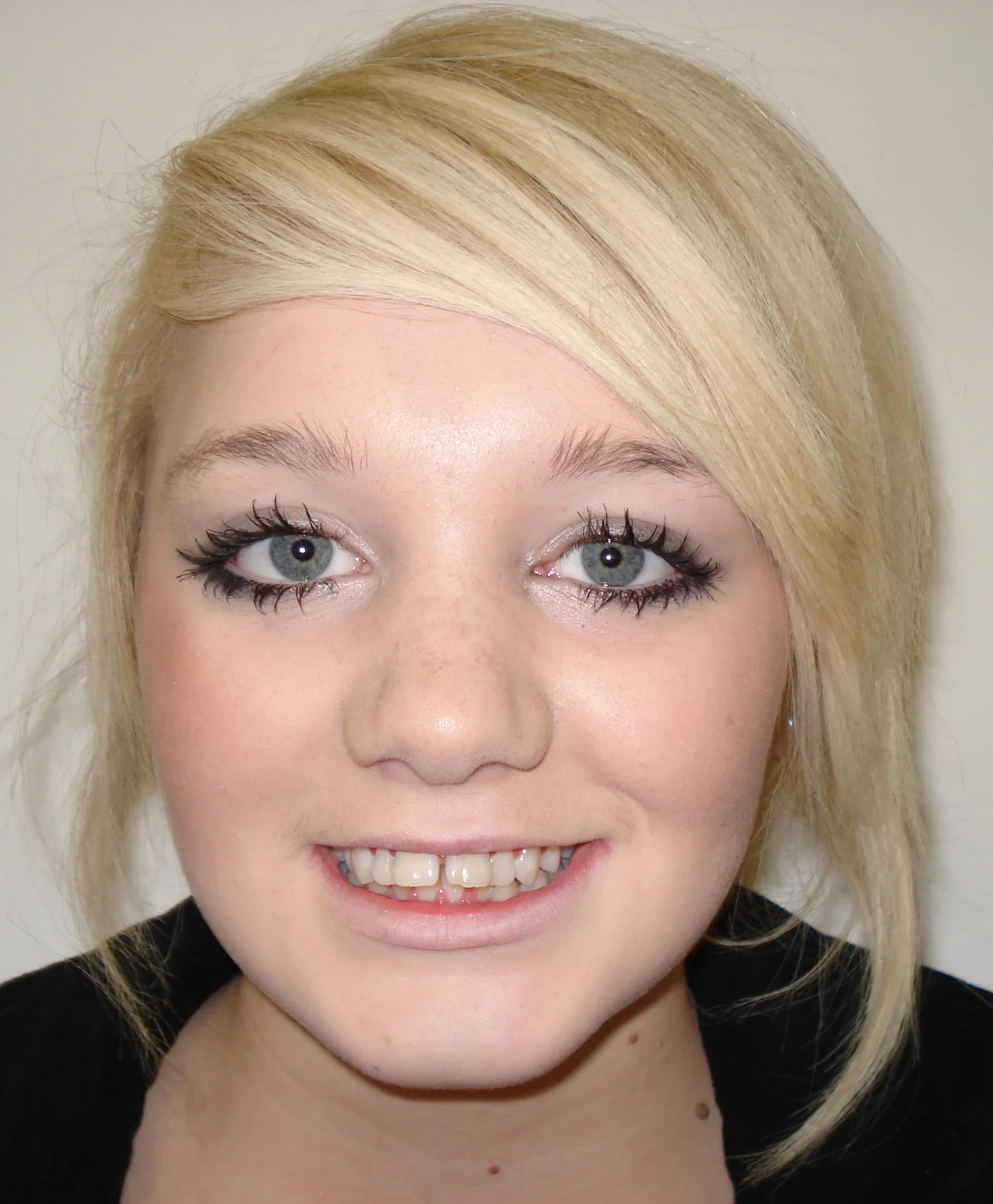 metal braces before