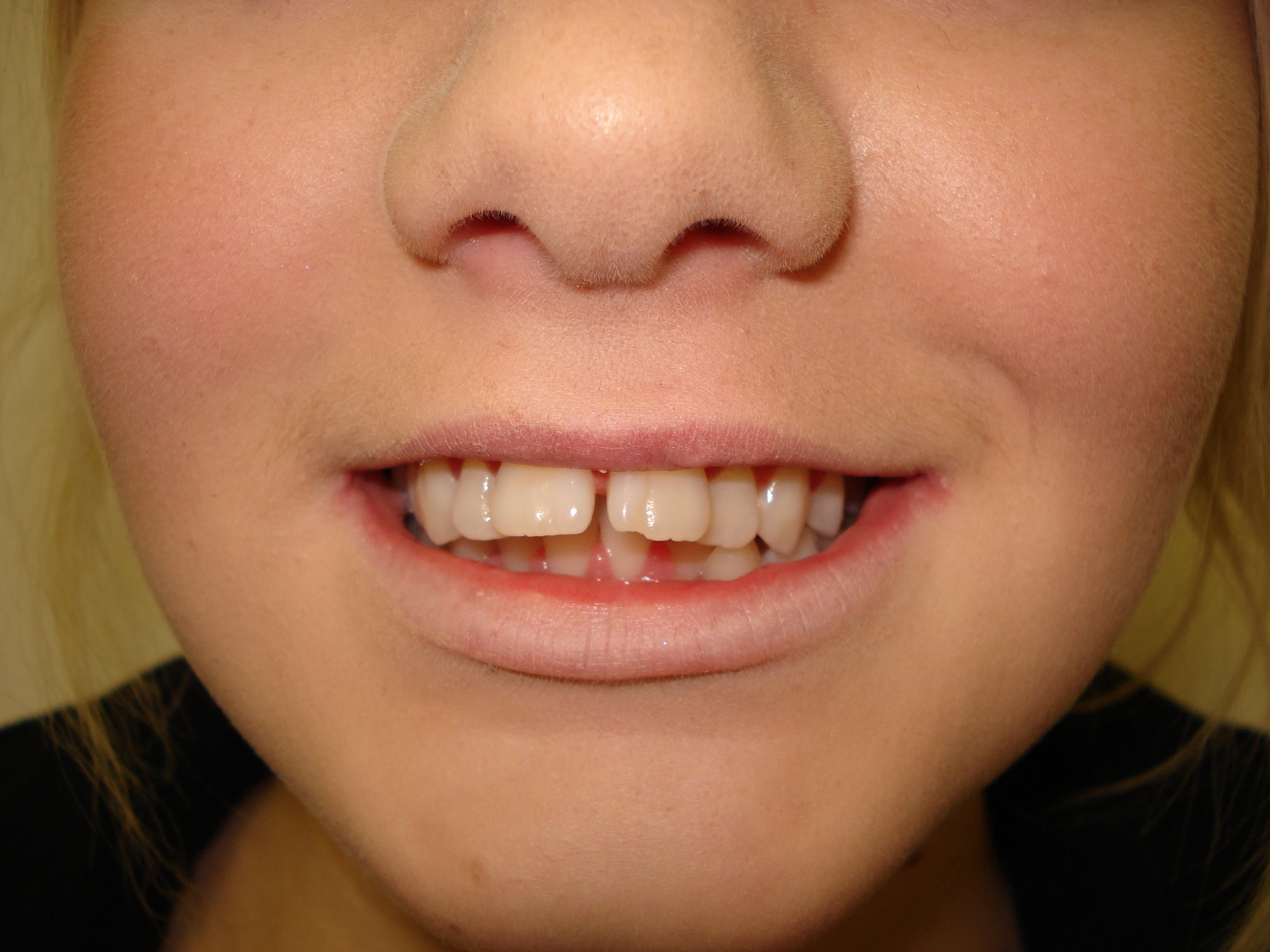 a closeup before photo of metal braces patient 