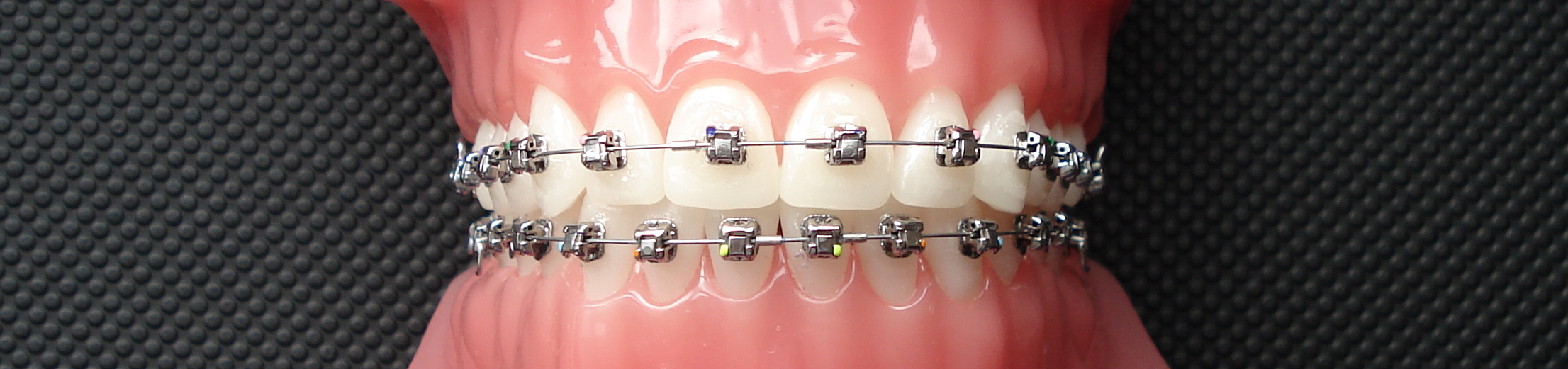 Damon Metal Fixed Braces at available at Brace Club in Guildford, Surrey.