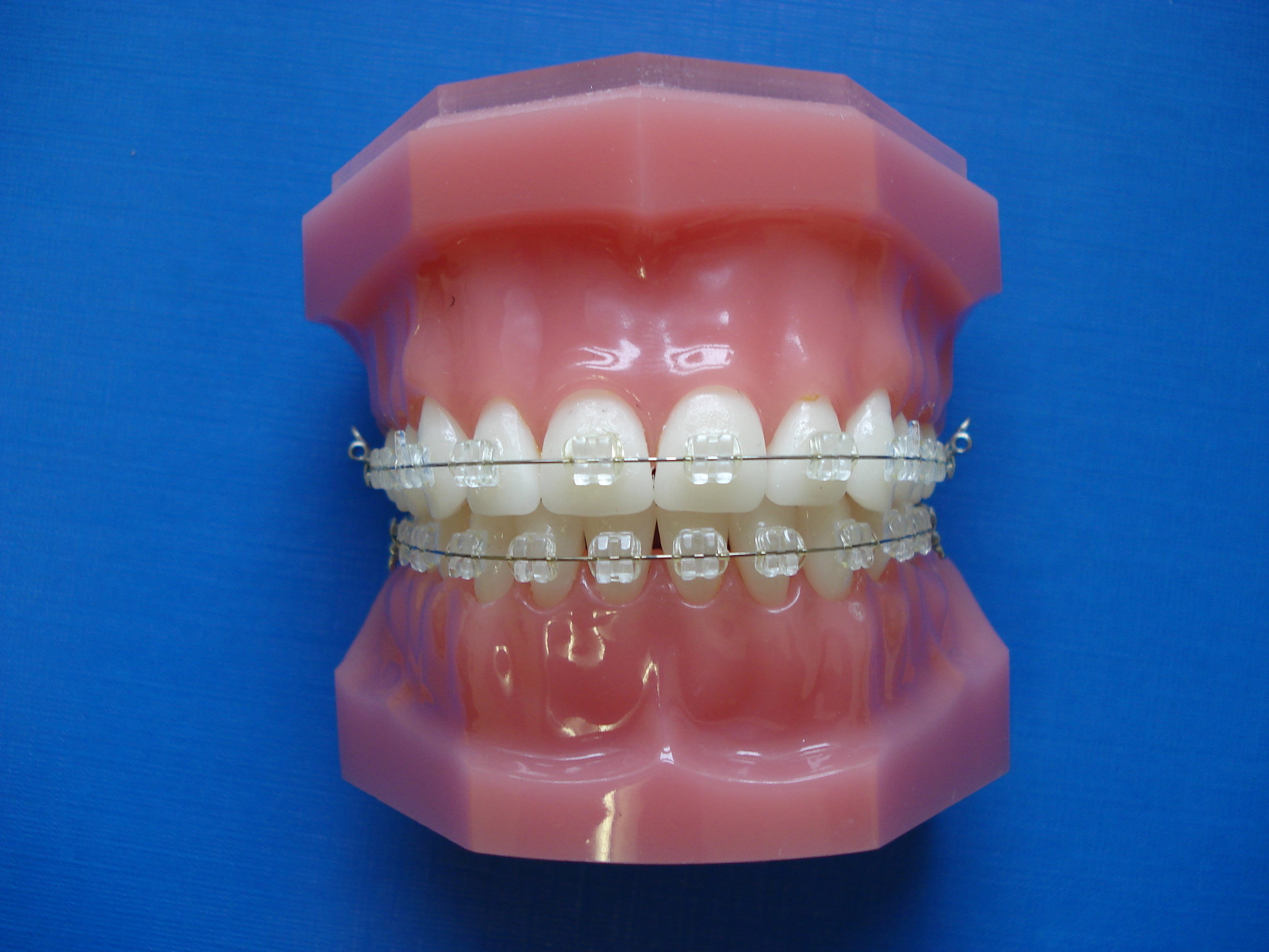 Clarity Ceramic Braces from 3M are available at Brace Club in Guildford, Surrey.