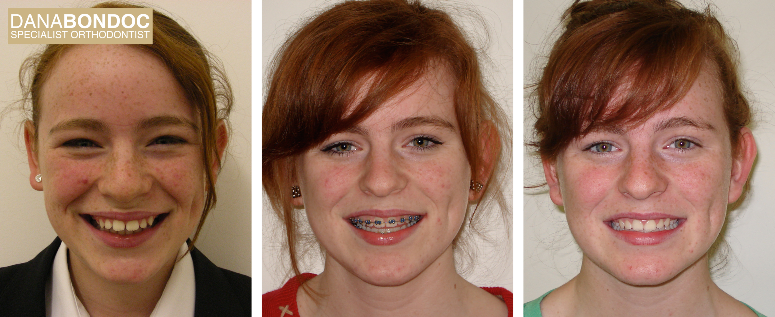 Before treatment, with metal braces on, after treatment photos of female teenager for the treatment of protrusion or commonly mistaken as an overbite.