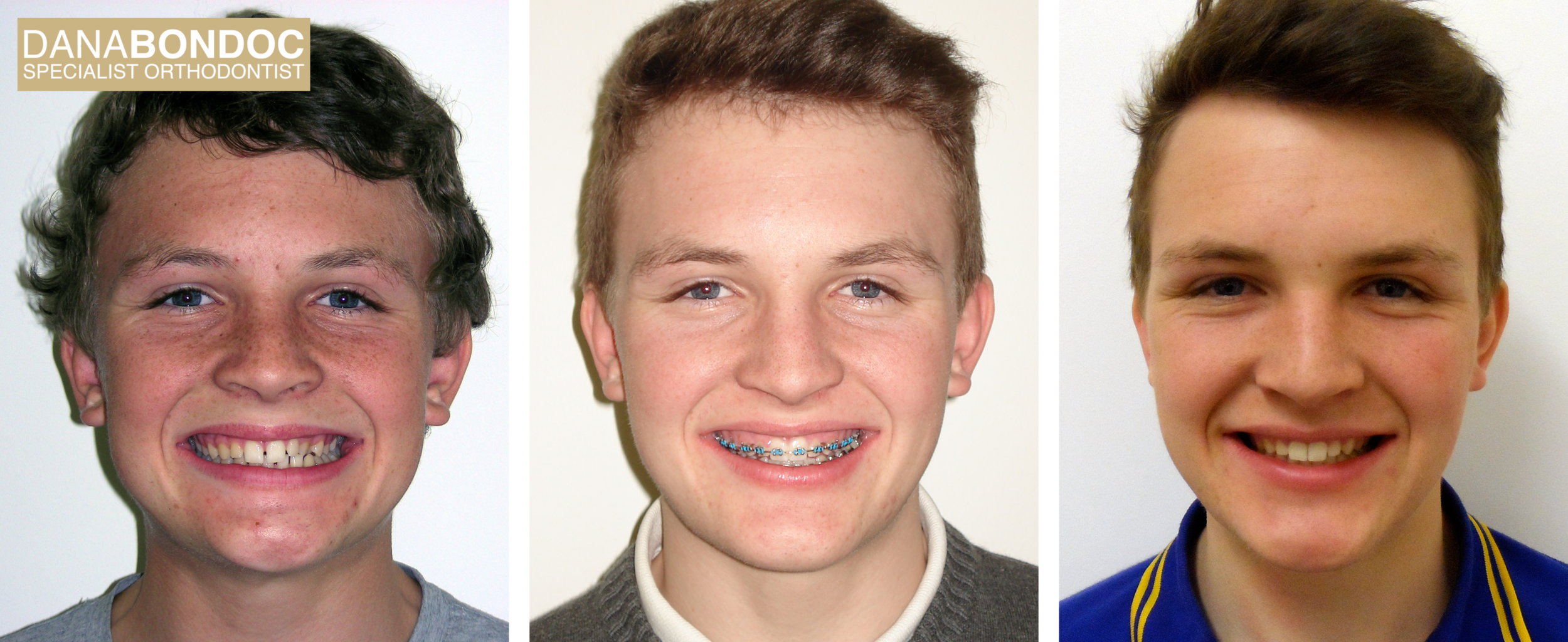 Before treatment, with metal braces on, after treatment photos of a male teenager for the treatment of spacing and an anterior cross bite.