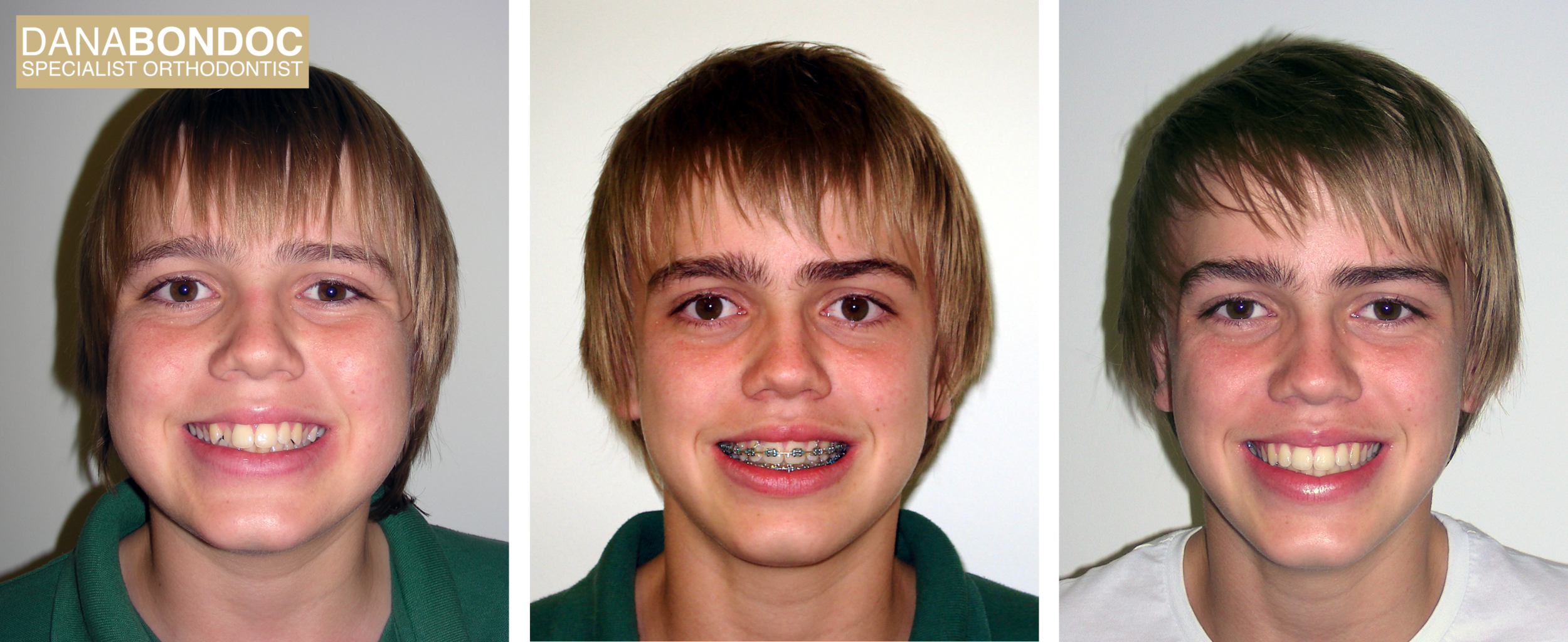 Before treatment, with metal braces on, after treatment photos of a male teenager for the treatment of an anterior cross bite.