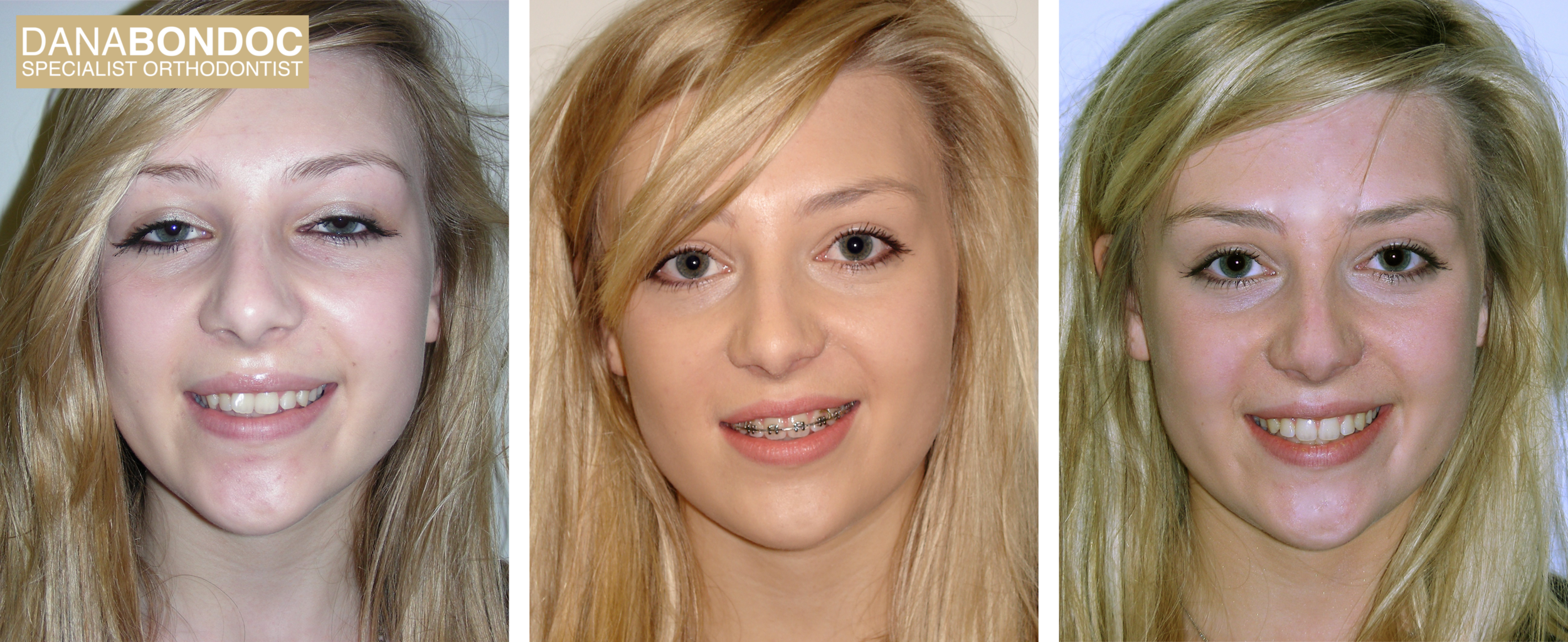 Before treatment, with metal braces on, after treatment photos of a female teenager and written testimonial.