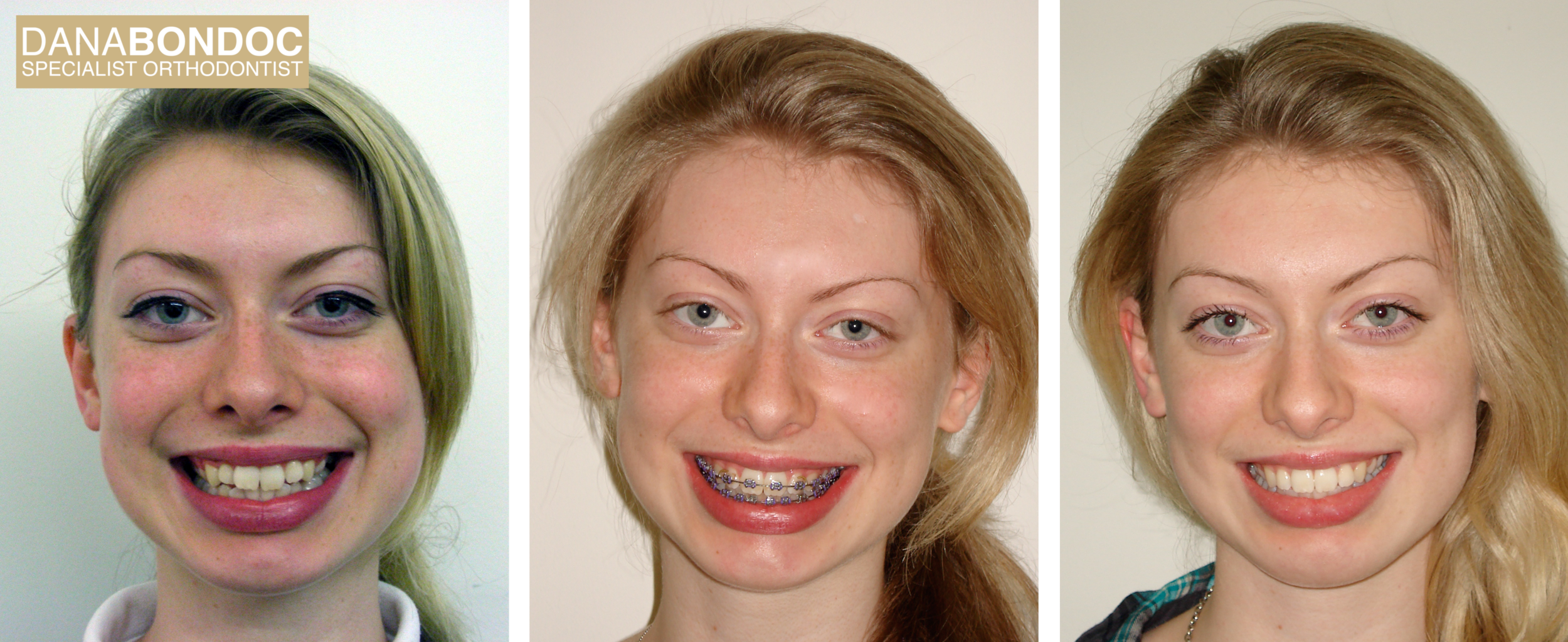 Non-extraction treatment, Before treatment, with metal braces on, after treatment photos of a female teenager and written testimonial.