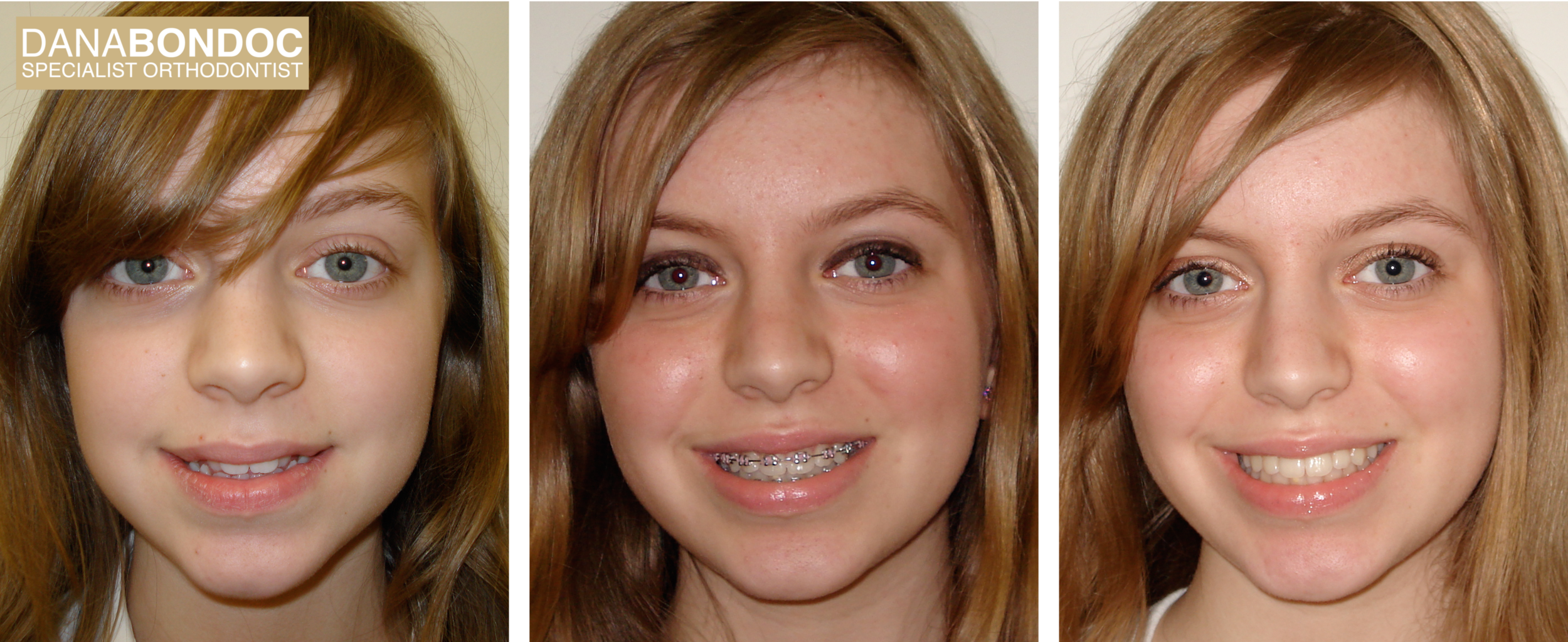 Narrow smile, before treatment, with metal braces on, after treatment photos of a female teenager and written testimonial.