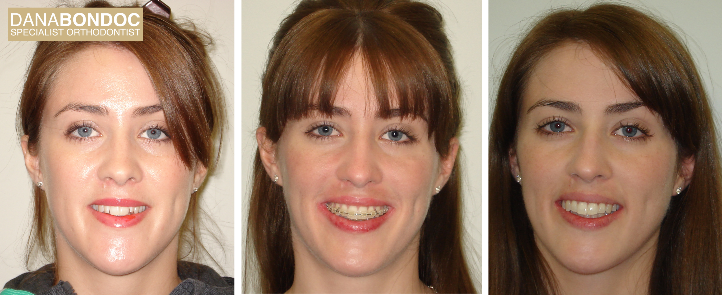 Before treatment, with clear braces on, after treatment photos of female adult patient plus a written testimonial. 