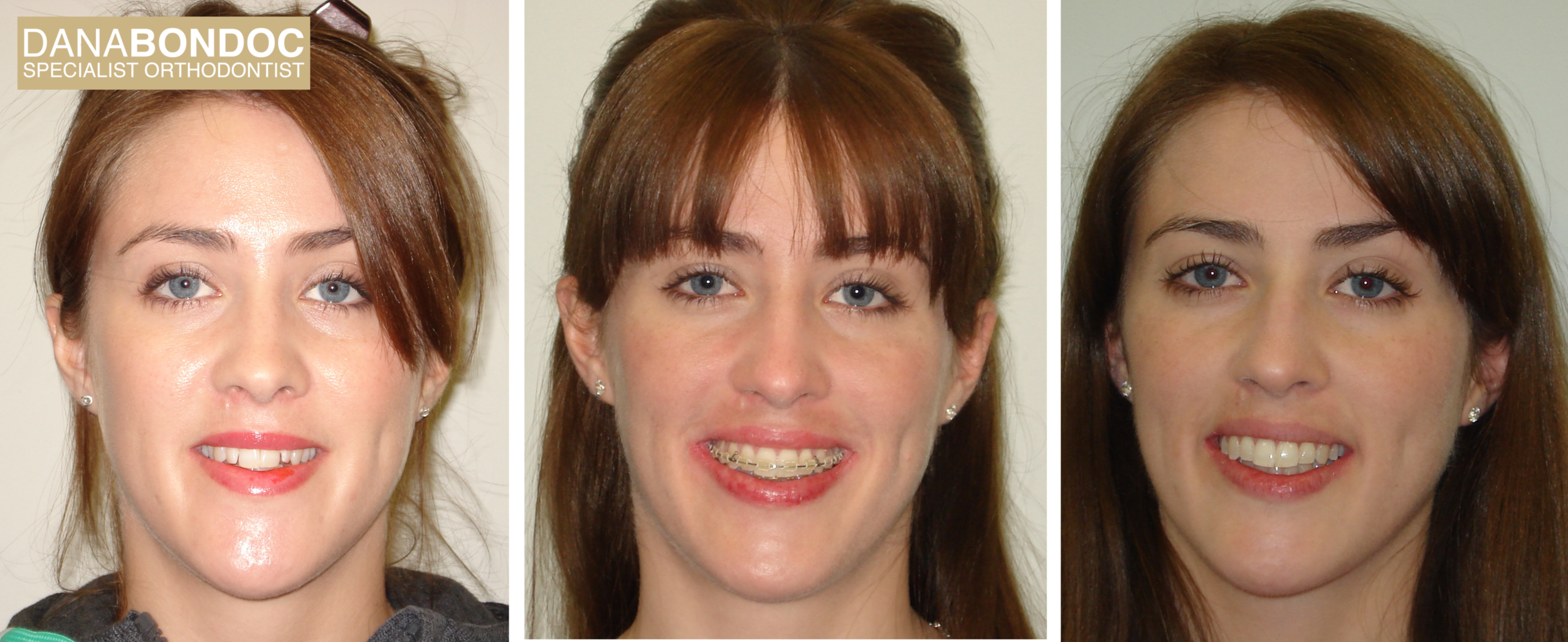 clear braces adult patient 1