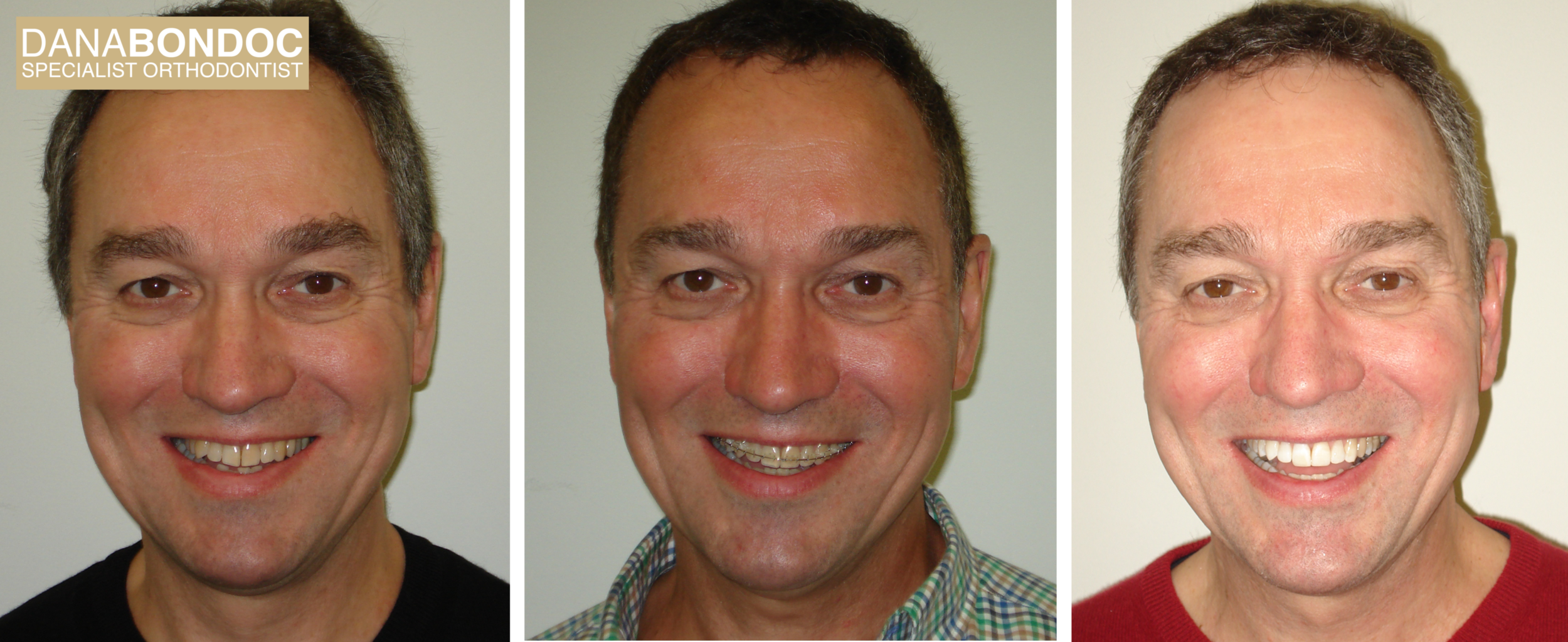 Before treatment, with clear braces on, after treatment photos of male adult patient plus a written testimonial.