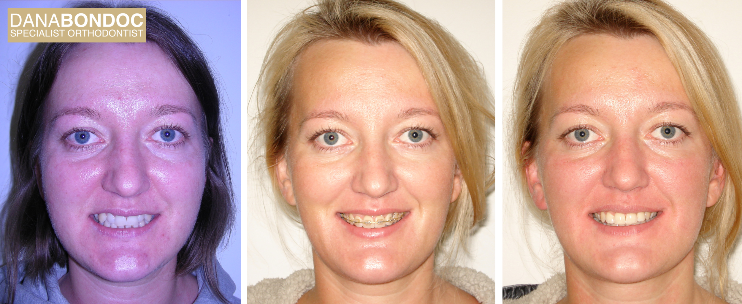 Before treatment, with clear braces on, after treatment photos of female adult patient.