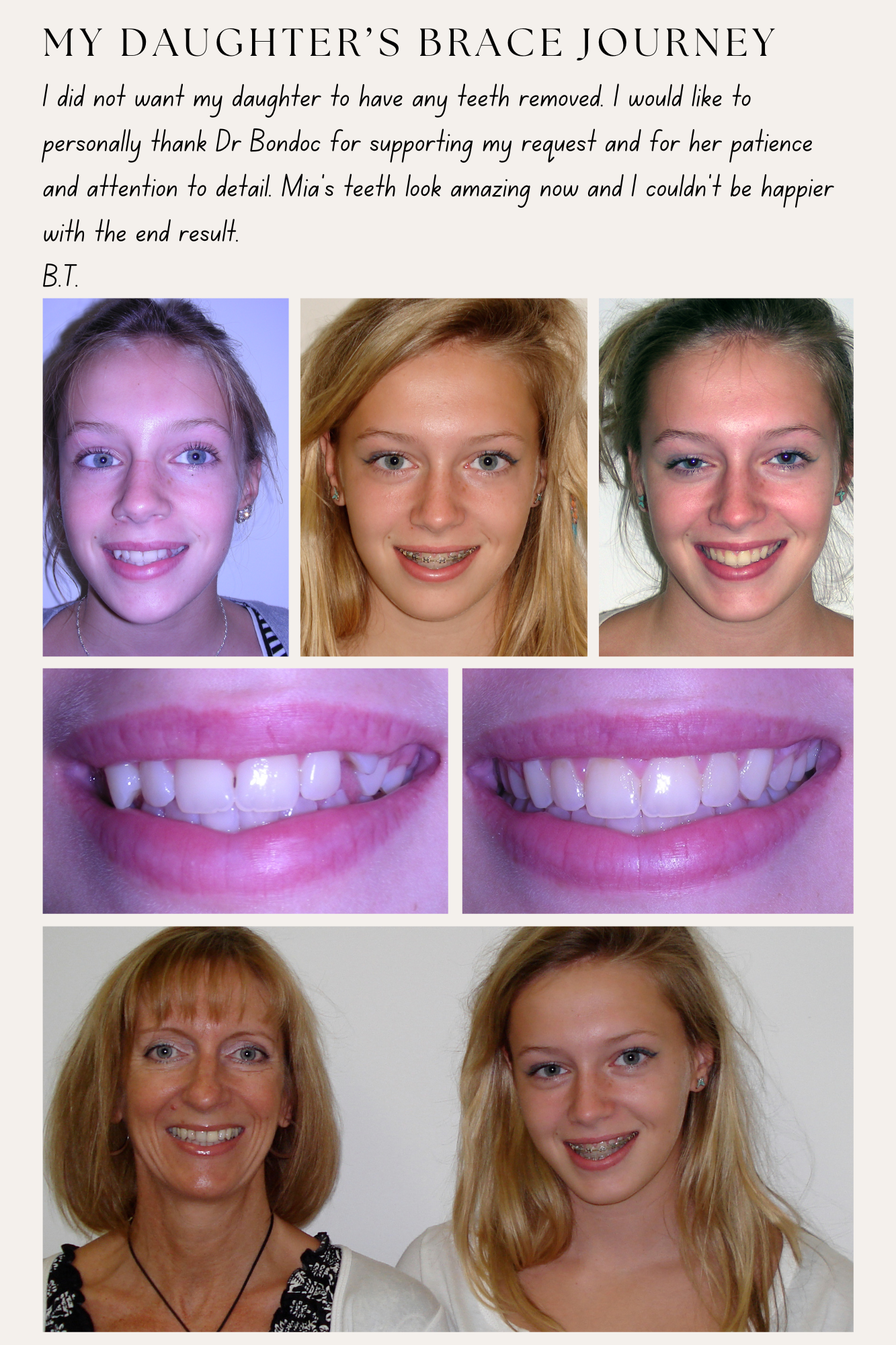 Before treatment, with metal braces on, after treatment and with parent photos of a female teenager patient plus a written testimonial. 