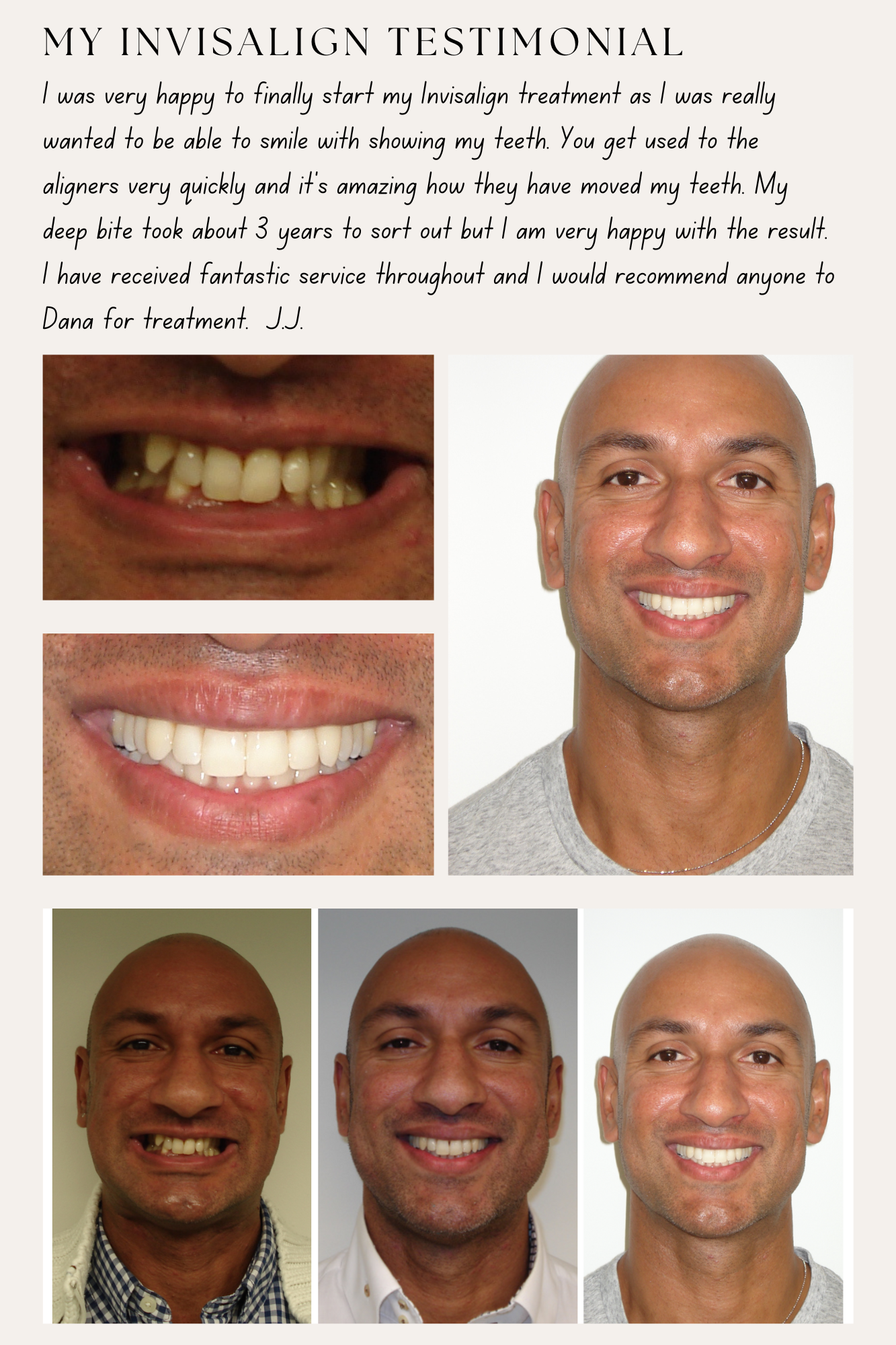 Before treatment, with Invisalign attachments on, after treatment photos and written testimonial of an adult patient completed by Dr Dana Bondoc.