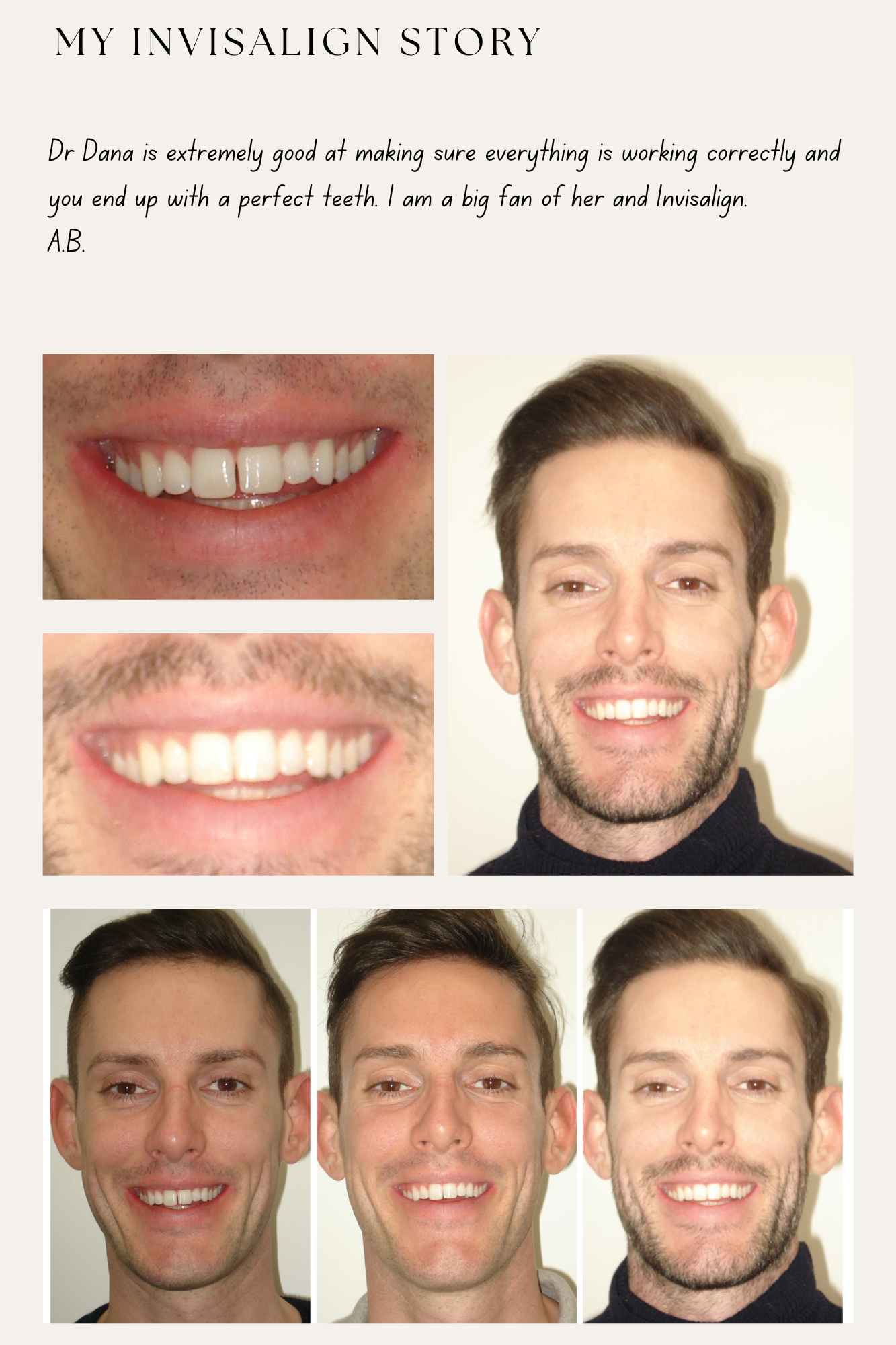 Before treatment, with Invisalign attachments on, after treatment photos and written testimonial of an adult patient completed by Dr Dana Bondoc.
