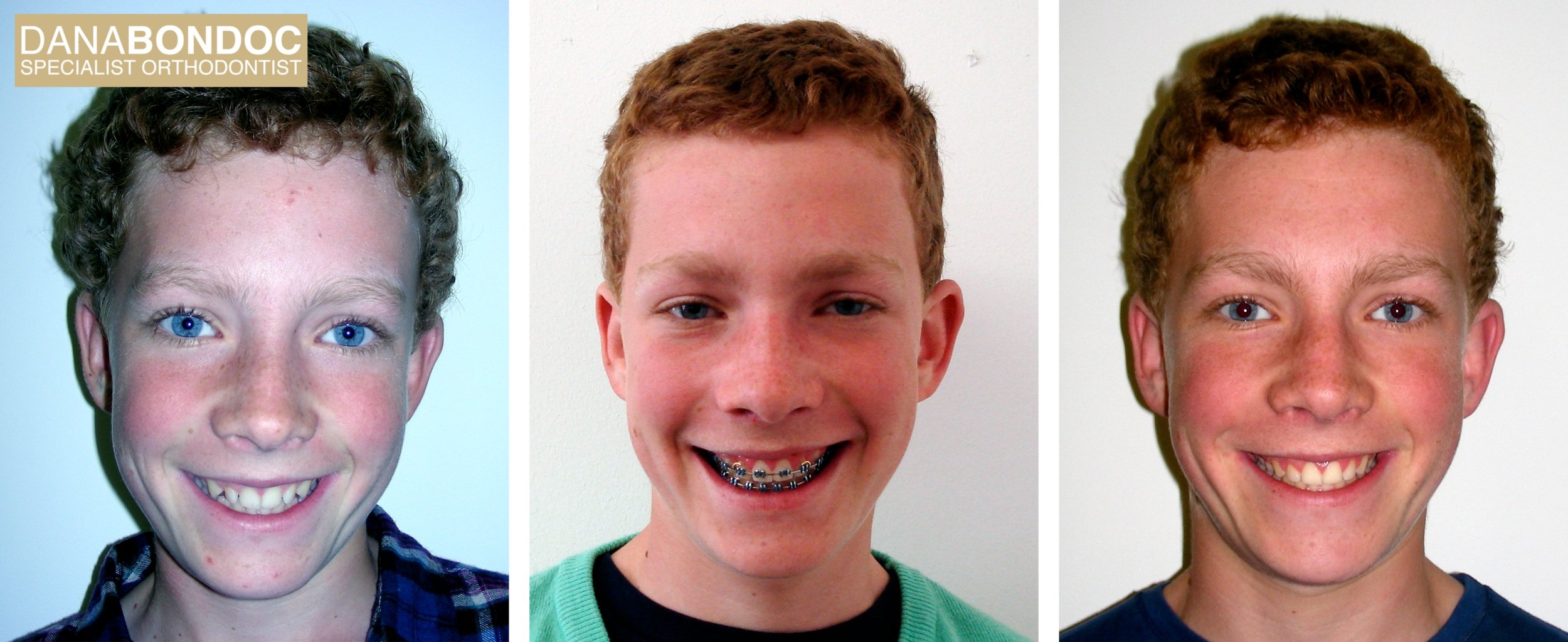 Before treatment, with metal braces on, after treatment photos of a male teenager and written testimonial.