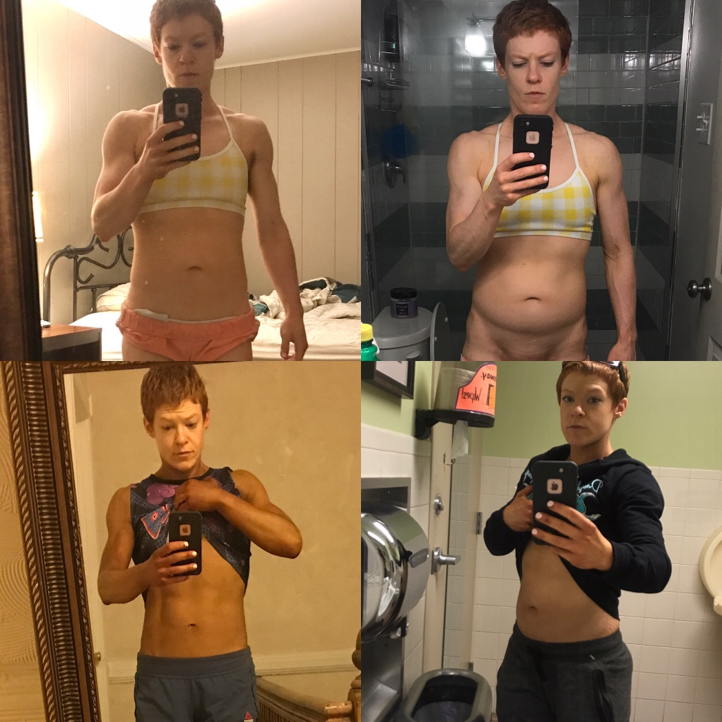 Comparison photos. Top 12 hours apart. Bottom about 30 hours apart. The water bloat was so much that I icily referred to the new addition to my abdomen as my “marsupial pouch”. It could have held a baby wombat.