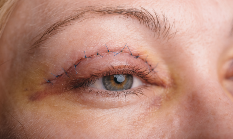 Close up of upper eyelid with temporary suture following eyelid surgery