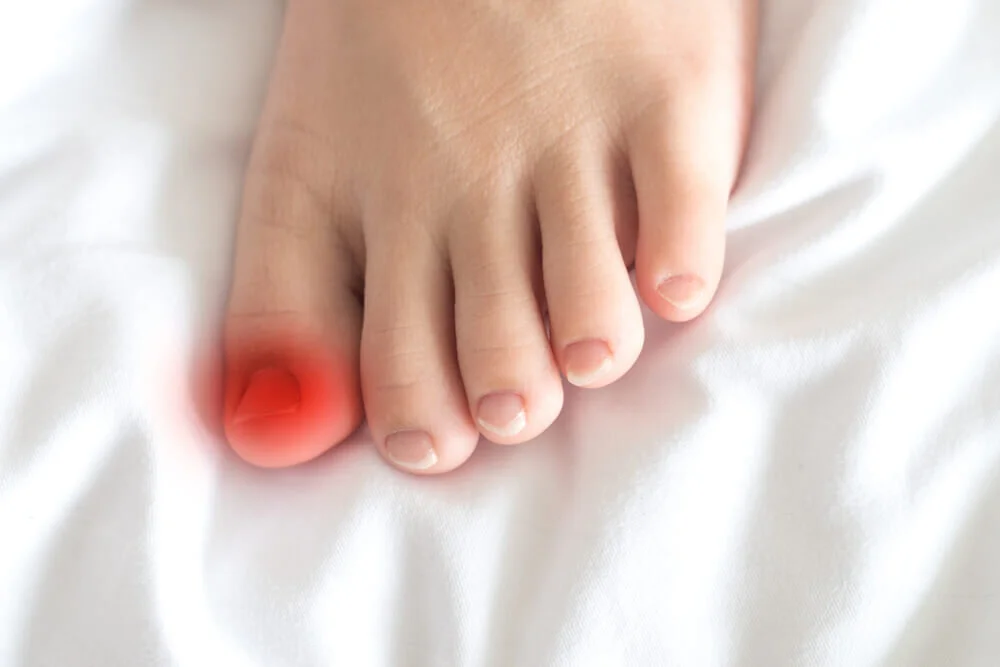 ingrown toenail catskill ny podiatrist  Michelle Zhubrak