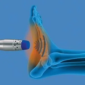 Shockwave Therapy Relieves Heel Spur Pain