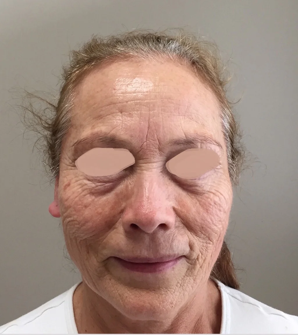 Before first REJUVENATE Treatment