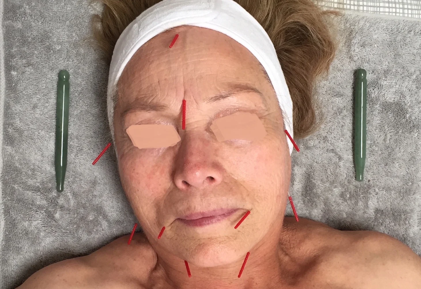 First Cosmetic Acupuncture Treatment