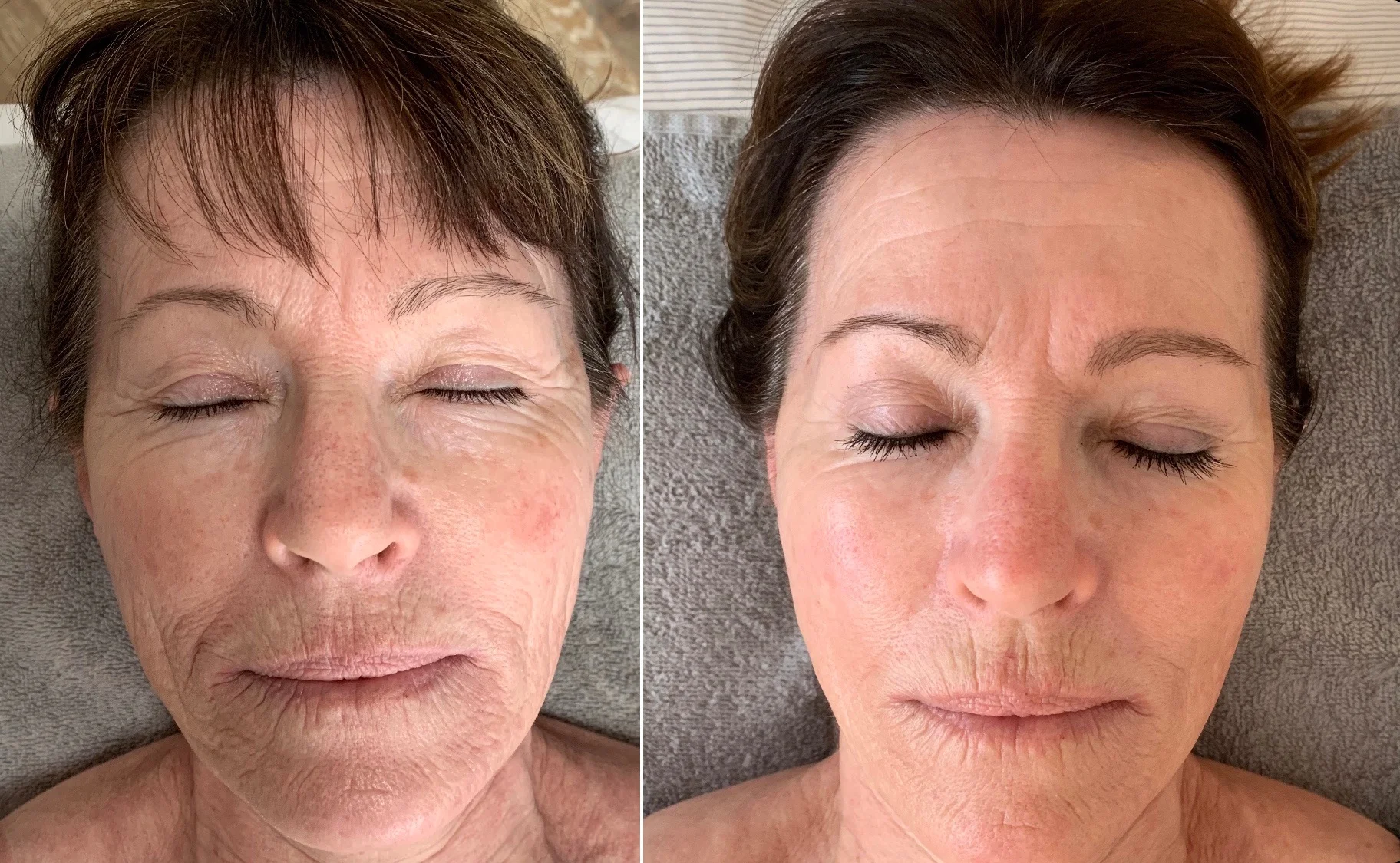 Facial Rejuvenation Ouchie