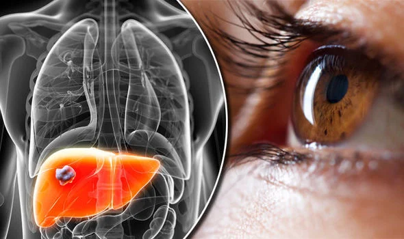 Heal Your Eyes By Healing Your Liver With Mineral Balancing