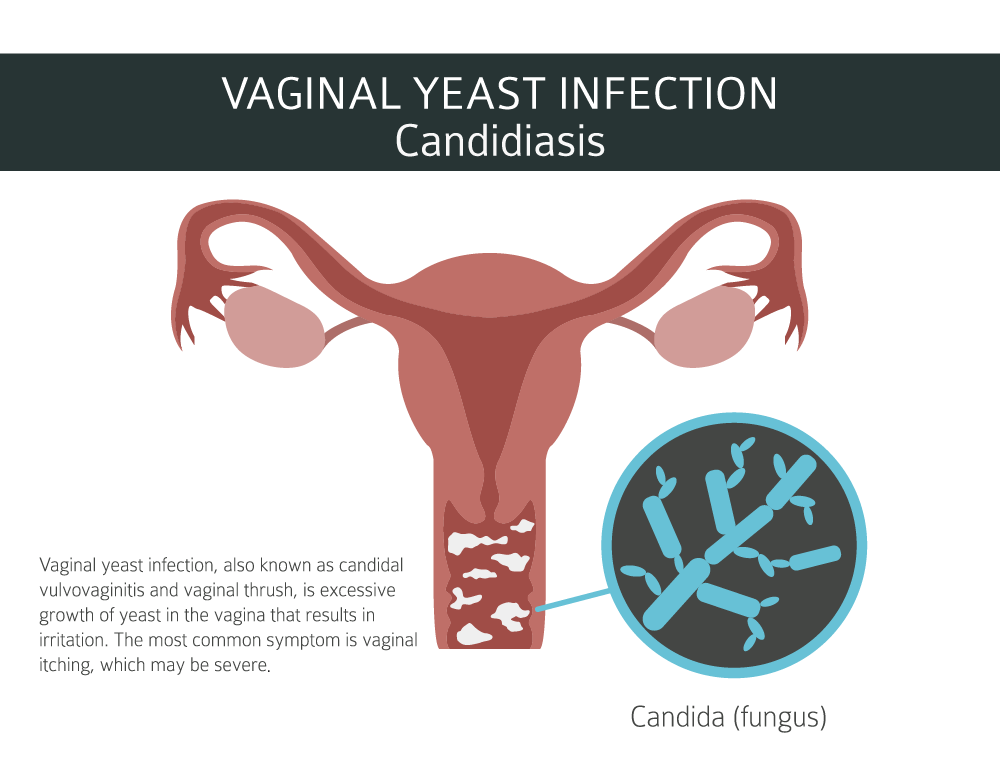 vaginal thrush back to natural health-01-01.png