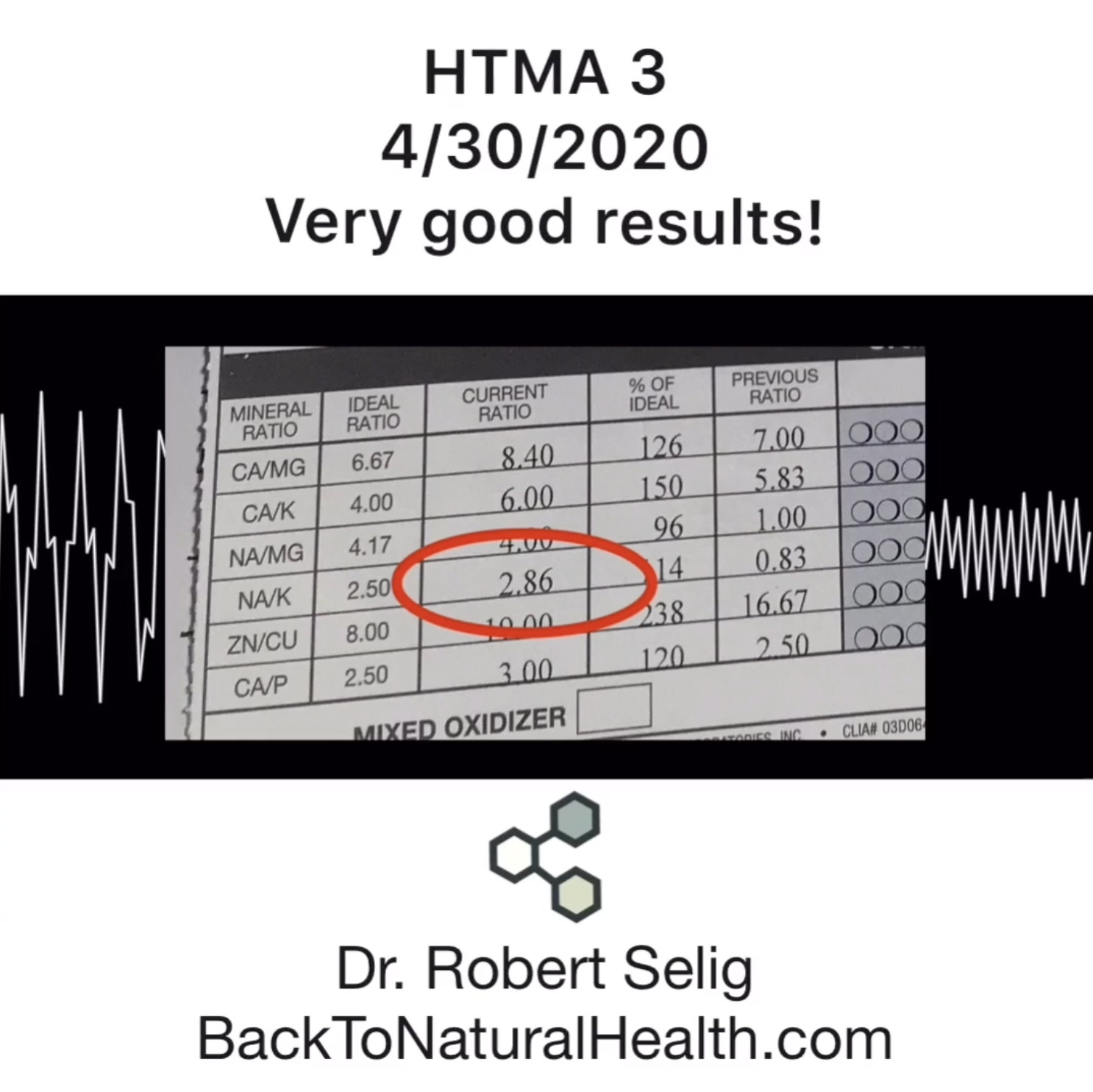 Case Study 43 Year Old Male: Healing Adrenal Fatigue, Depression, Anxiety, &amp; Brain Fog Naturally