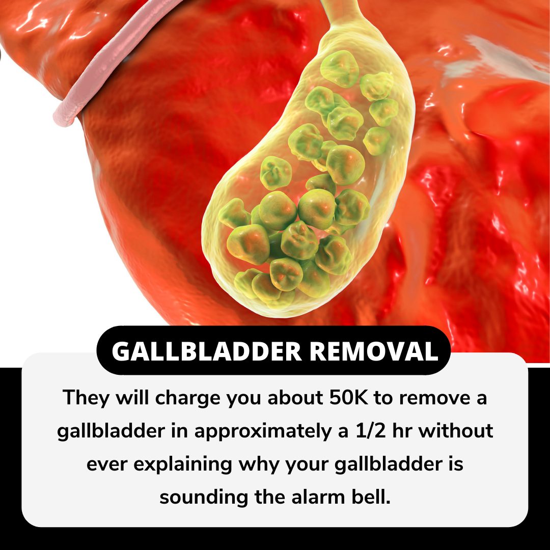 Gallbladder removal costs over $50k! Learn how to prevent it…