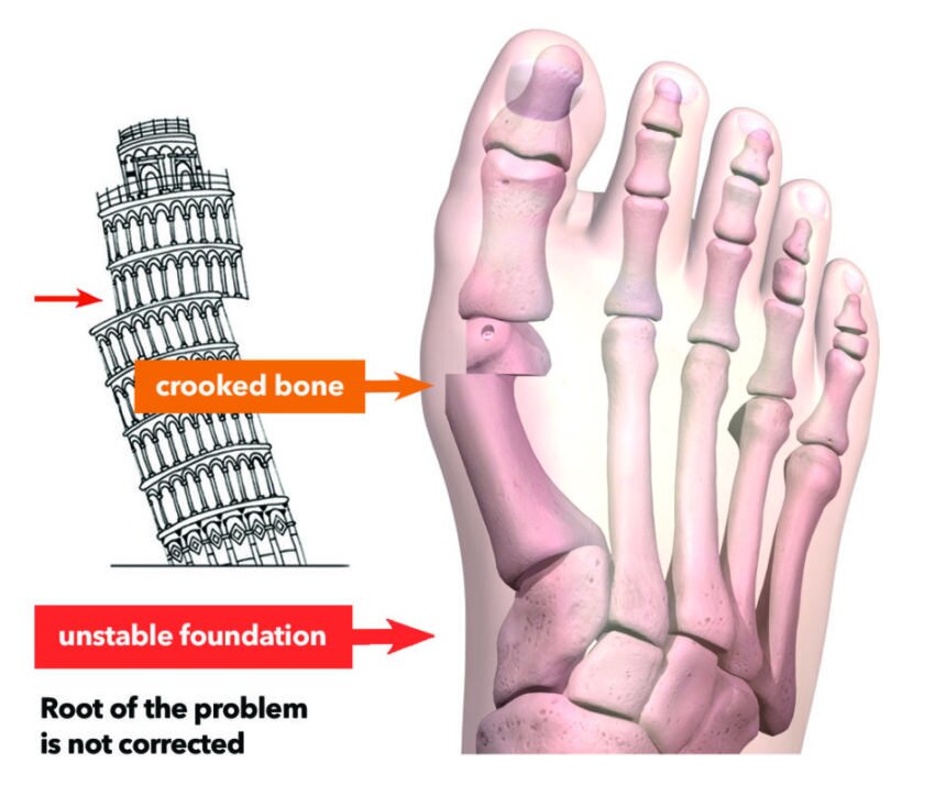 Traditional Bunion Surgery