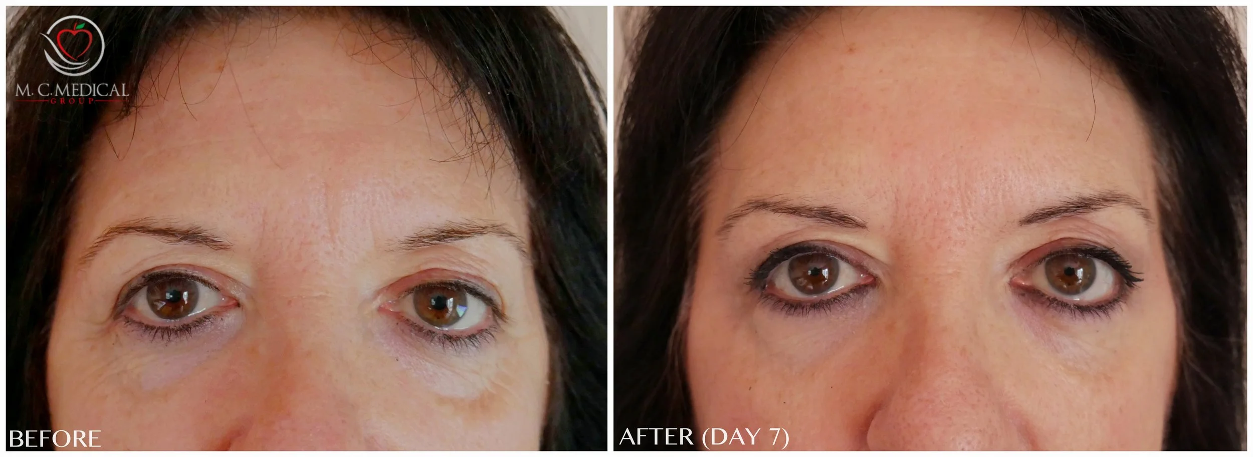 new-before-after-botox.jpg