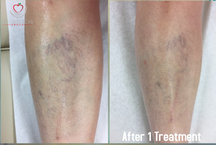 laser-vein-treatment.png