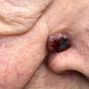 A basal cell carcinoma.
