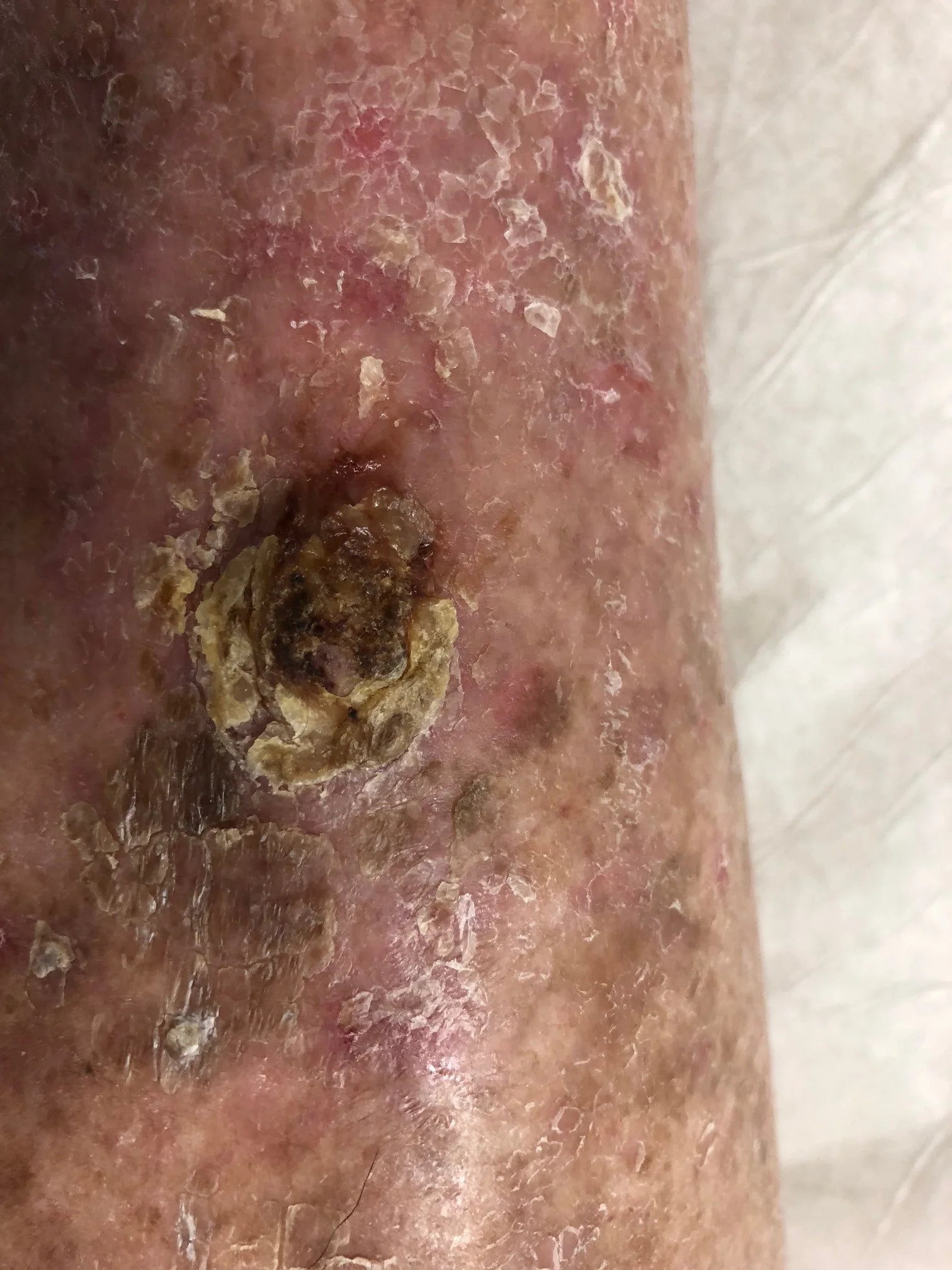 ... in a chronic wound 