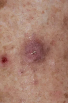 ... on sun-exposed skin 