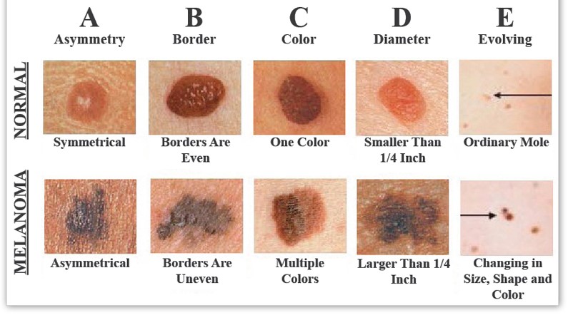 skin-cancer-chart.jpg