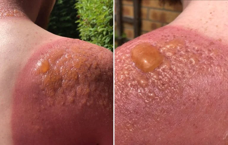 man-blisters.jpg