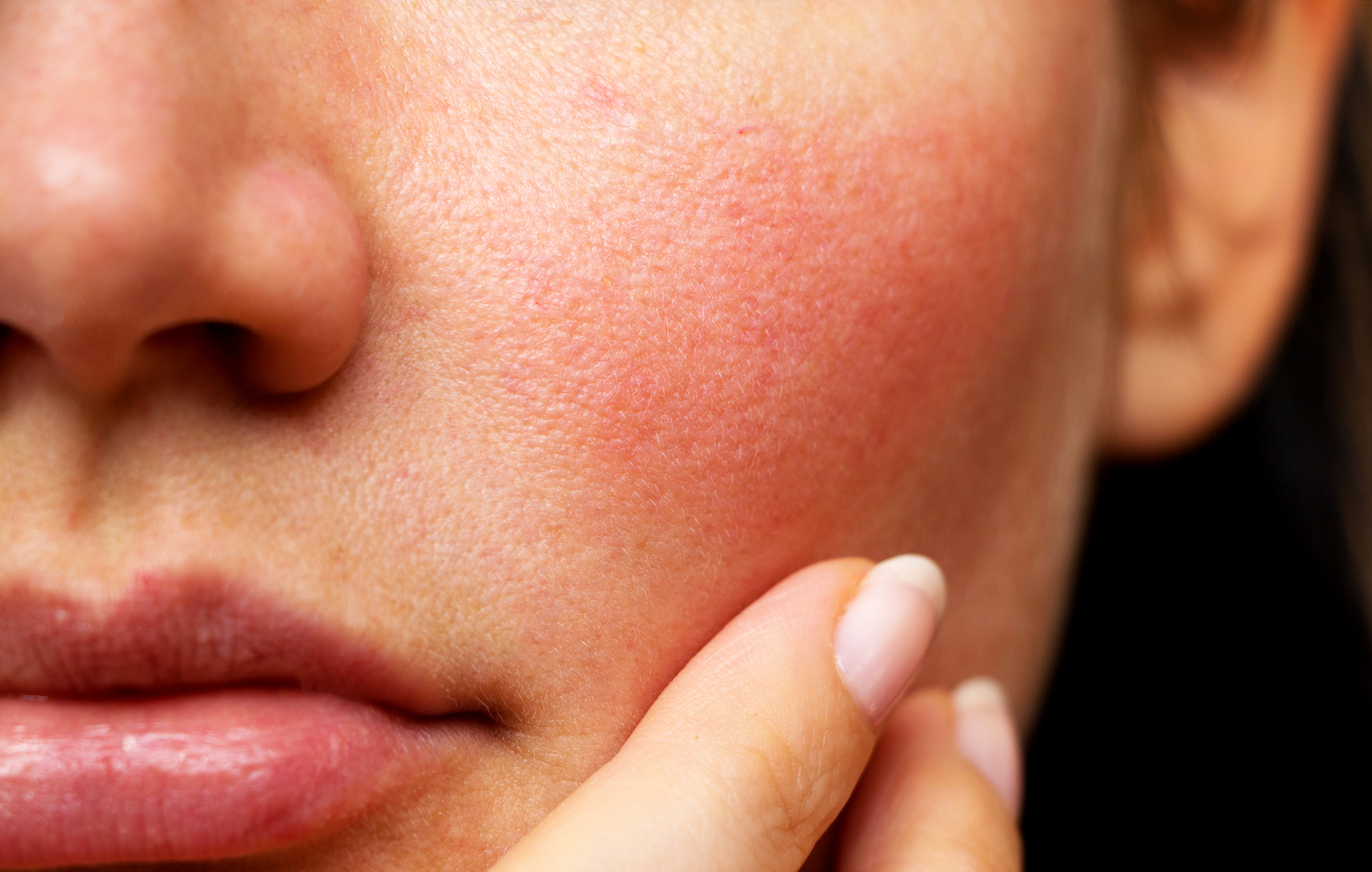 هیالورونیک اسید برای پوست حساس