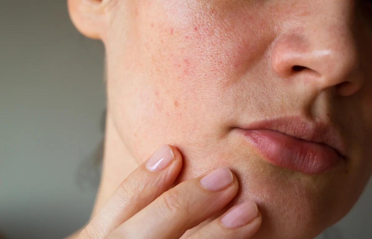 Nordora_Dry-Skin.jpg