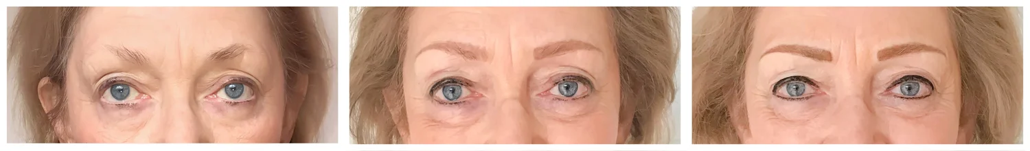 From left: before procedure, 6 weeks HEALED post-procedure, and 12 weeks final procedure