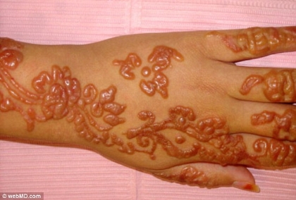 Chemical burns from PPD (aka 'black henna'). These burns often leave permanent scars. Natural henna paste is free from these dangerous additives.