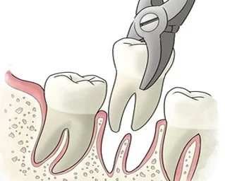 Extractions Extractions are always considered as a last resort or upon patient request. If a tooth has to be removed our office can do the extraction for you. In rare cases, we may refer you to an oral surgeon. Typically the procedure is painless, and you’ll feel only pressure.