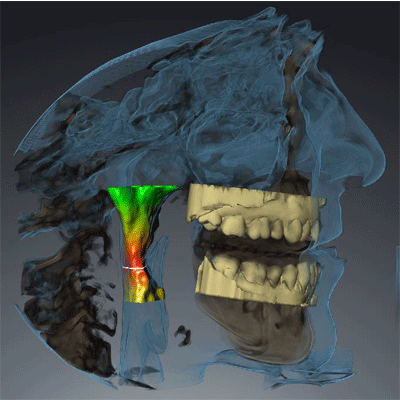 3D Airway Analysis for Obstructive Sleep Apnea Appliance Planning