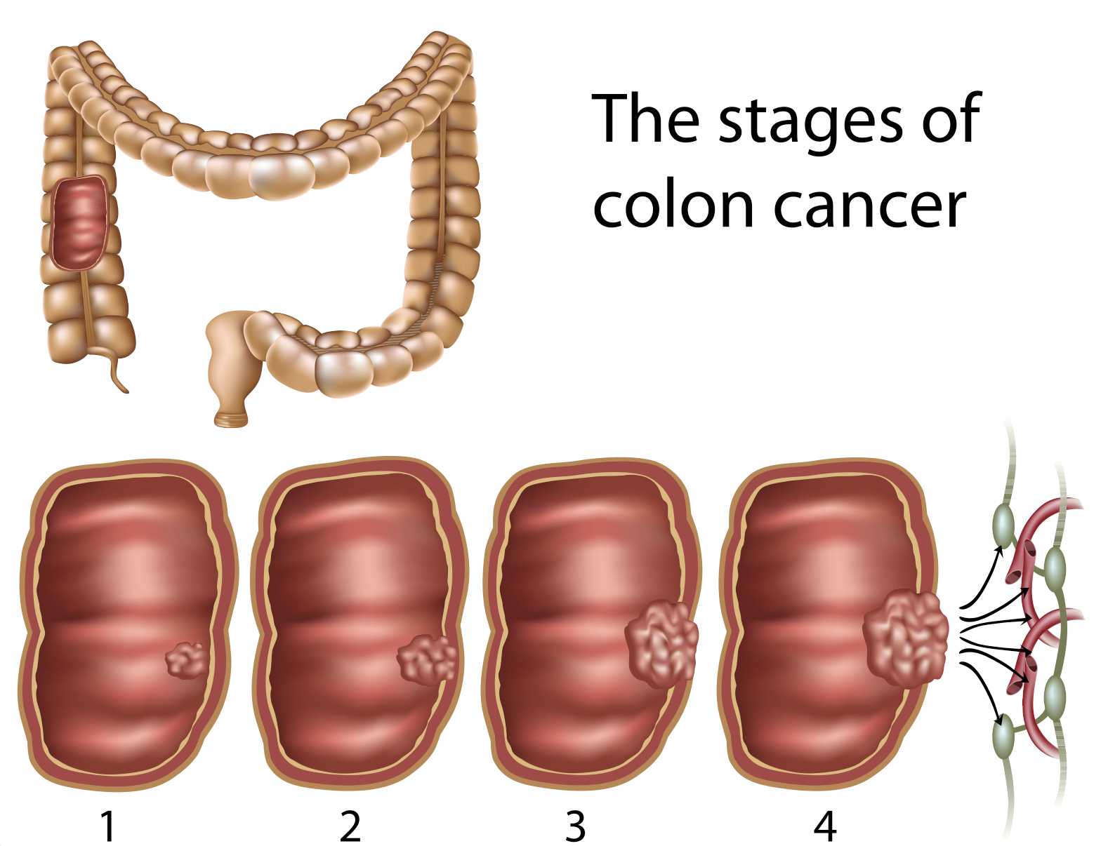 cancer colon nivel 4)
