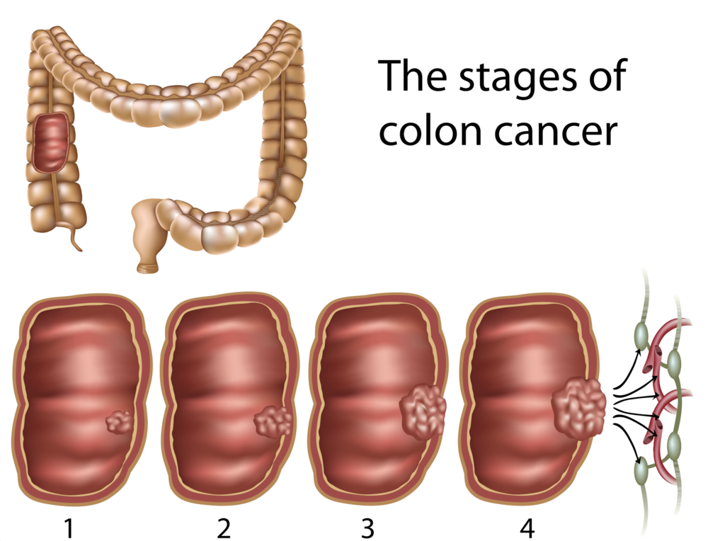 cancer de colon etapa 4