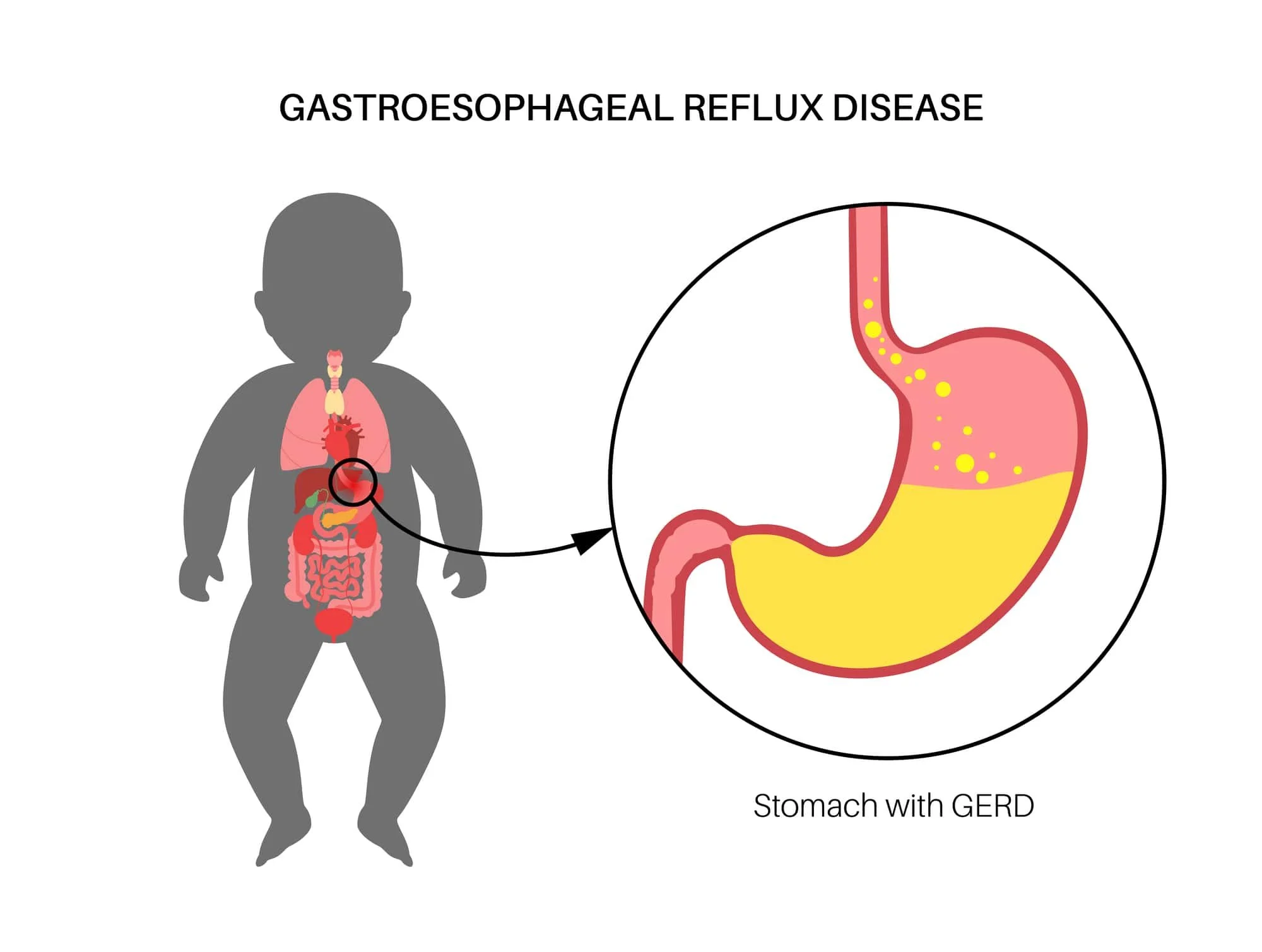 How to Effectively Treat Acid Reflux In Infants An Interview with
