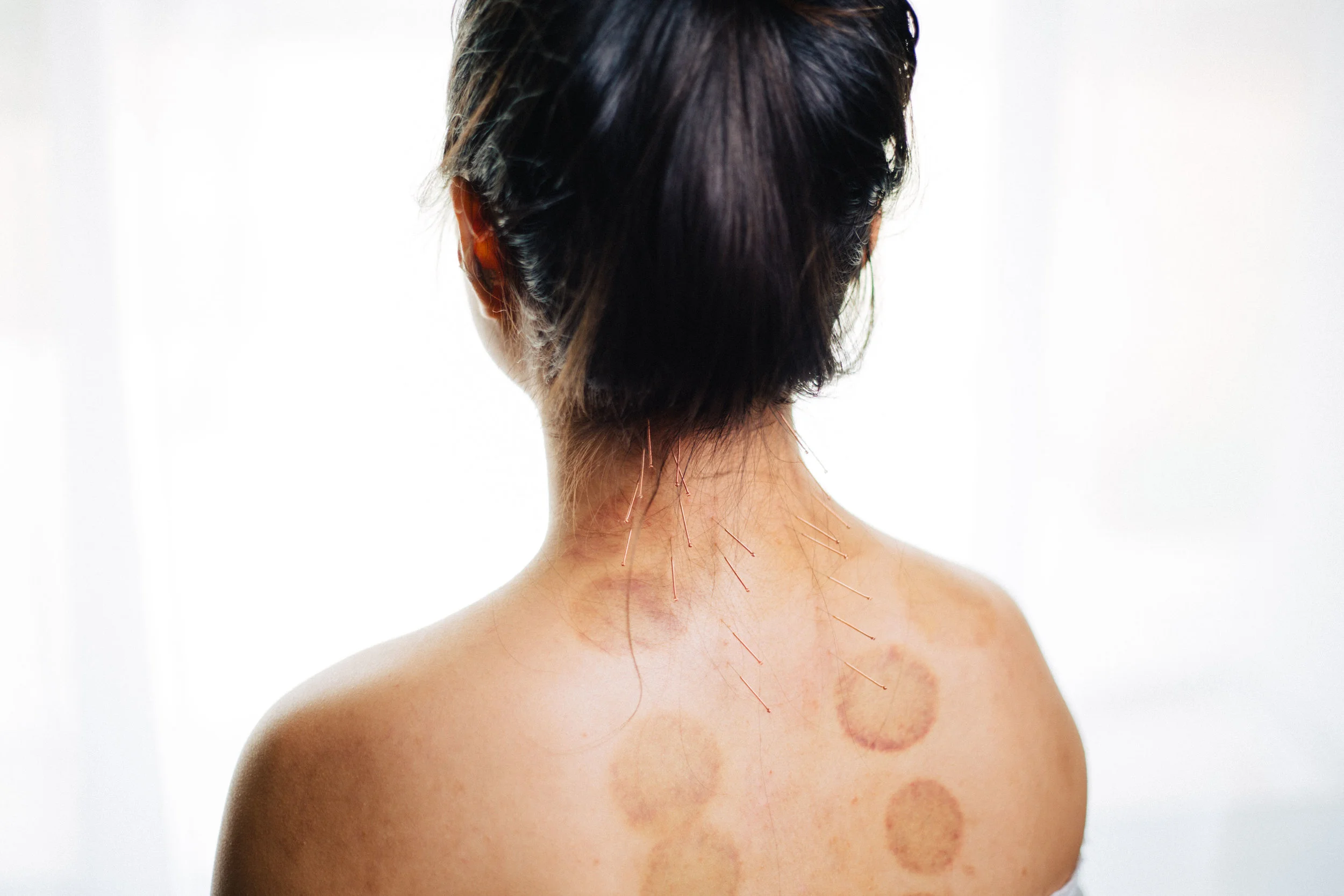 Tim Chow_Cupping Marks.jpg